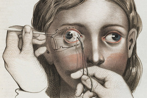 Žozefas Pancoastas. „Žvairumo korekcijos operacija“, 1846 m., Wellcome biblioteka, Londonas, Didžioji Britanija