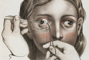 Joseph Pancoast. Strabismus correction surgery, 1846. Wellcome Library, London, United Kingdom